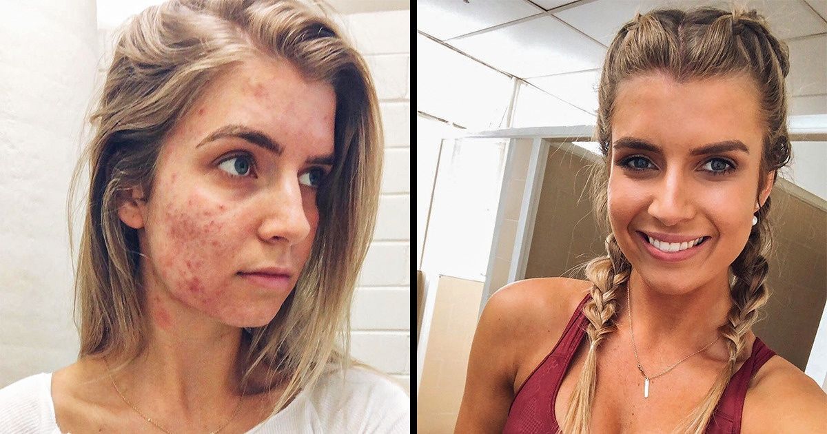 Pesquisa diz que pessoas que têm acne envelhecem mais lentamente Pesquisa diz que pessoas que têm acne envelhecem mais lentamente