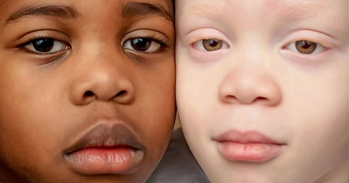 Gêmeos com tons de pele diferentes surpreendem a mãe no nascimento Gêmeos com tons de pele diferentes surpreendem a mãe no nascimento
