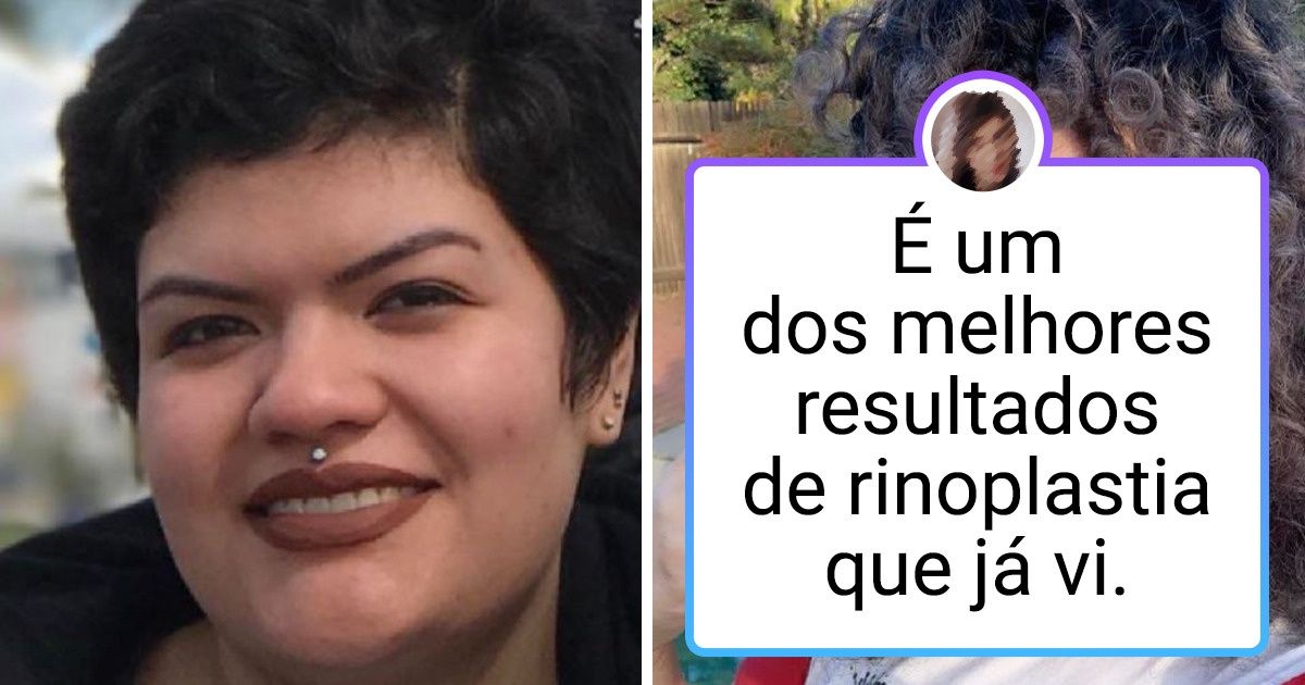 17 Pessoas que fizeram cirurgia plástica e ganharam uma nova aparência 17 Pessoas que fizeram cirurgia plástica e ganharam uma nova aparência