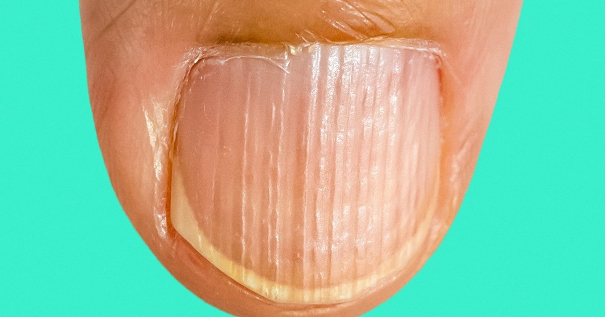 8 Sinais de que seu corpo está com falta de proteína