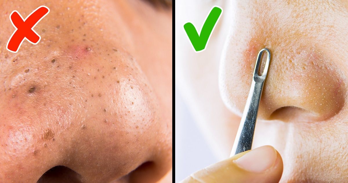 4 Maneiras eficientes de evitar e eliminar os cravos 4 Maneiras eficientes de evitar e eliminar os cravos