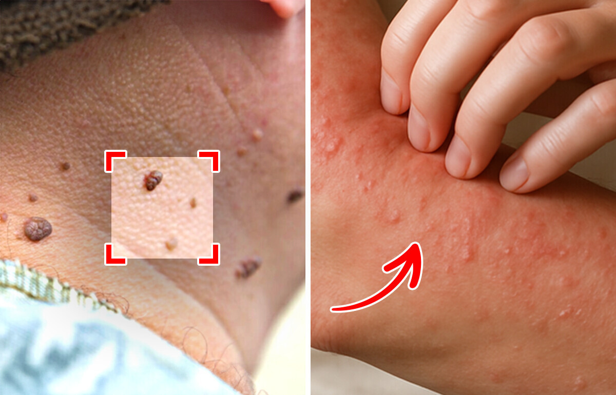 6 Sintomas silenciosos de diabetes que podem passar despercebidos