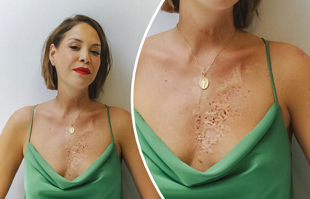 19 Famosas que abraçaram suas marcas e exibem o corpo com orgulho