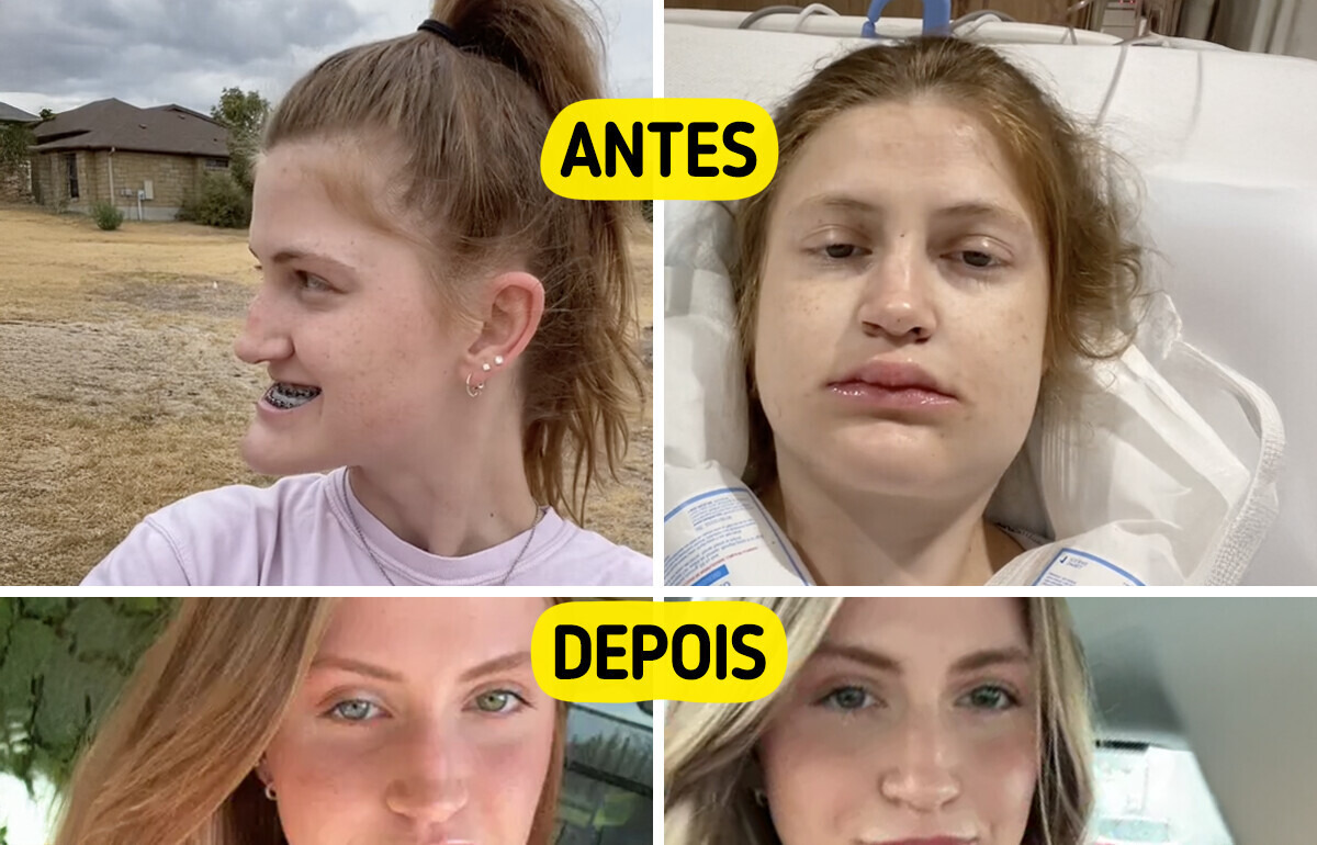 Jovem mostra a transformação após cirurgia na mandíbula e viraliza com o novo visual