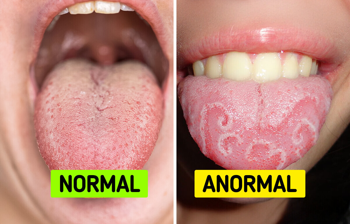 Entenda o que é saburra e confira 8 dicas de como tratá-la sem desespero Entenda o que é saburra e confira 8 dicas de como tratá-la sem desespero