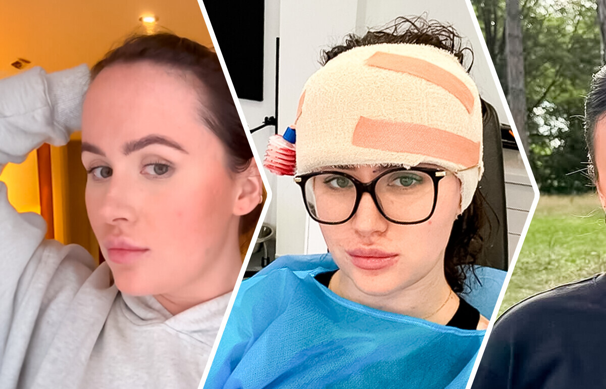 Sentindo vergonha do tamanho da testa, mulher opta por cirurgia plástica para reduzi-la