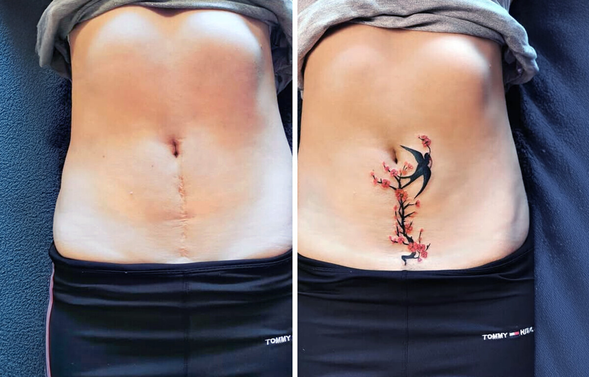 20+ Tatuagens que ajudaram pessoas a ressignificar suas cicatrizes