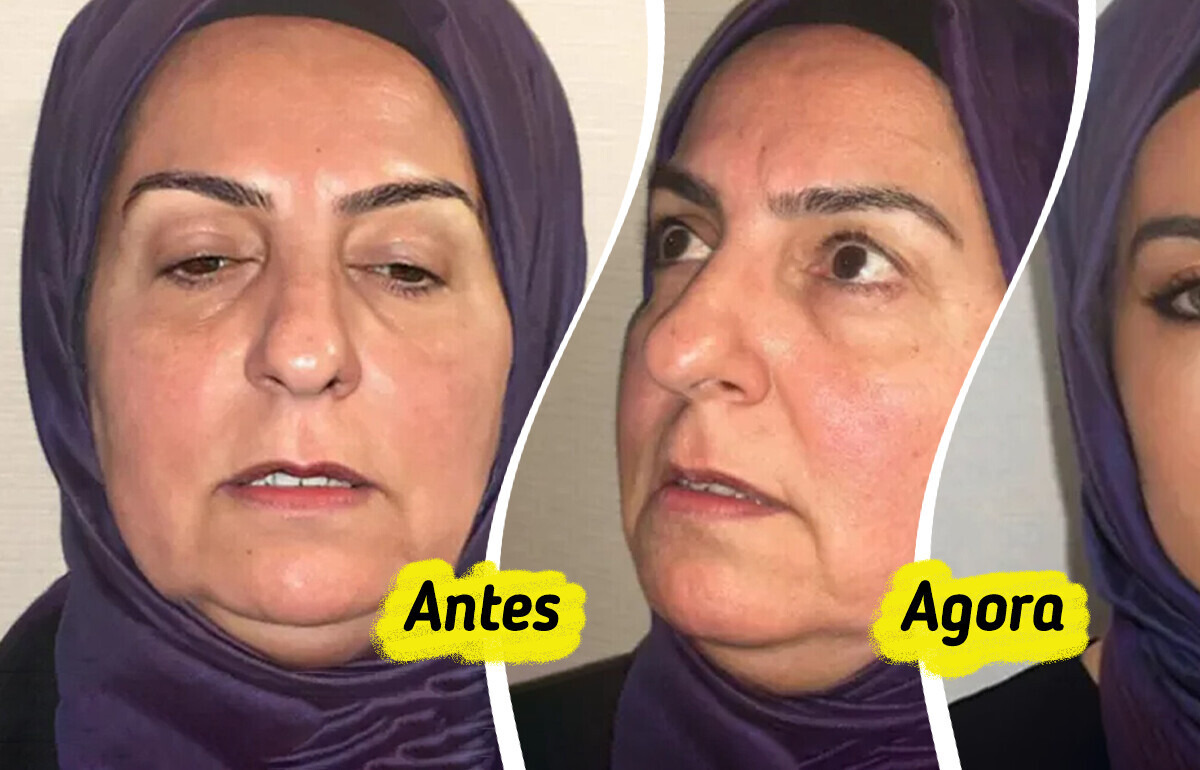 Cirurgia plástica de mulher de 68 anos tem antes e depois que deixou a internet incrédula