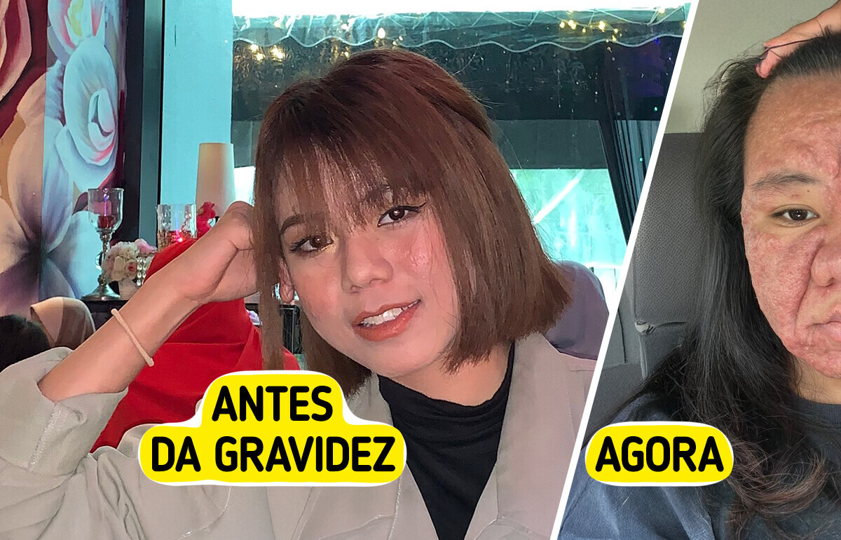 Mulher de 28 anos compartilha transformação chocante do rosto durante a gravidez com total honestidade