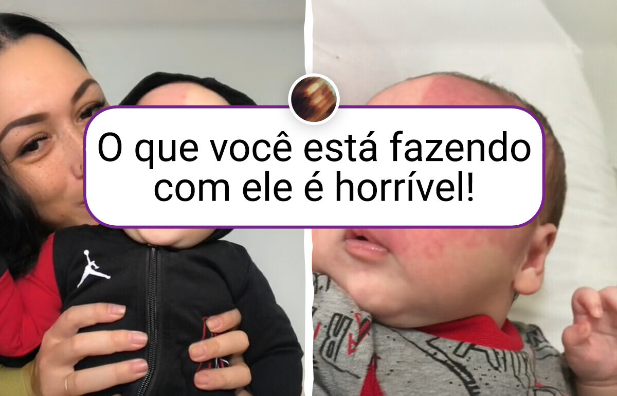 Remover marca de nascença do filho fez essa mãe receber duras críticas