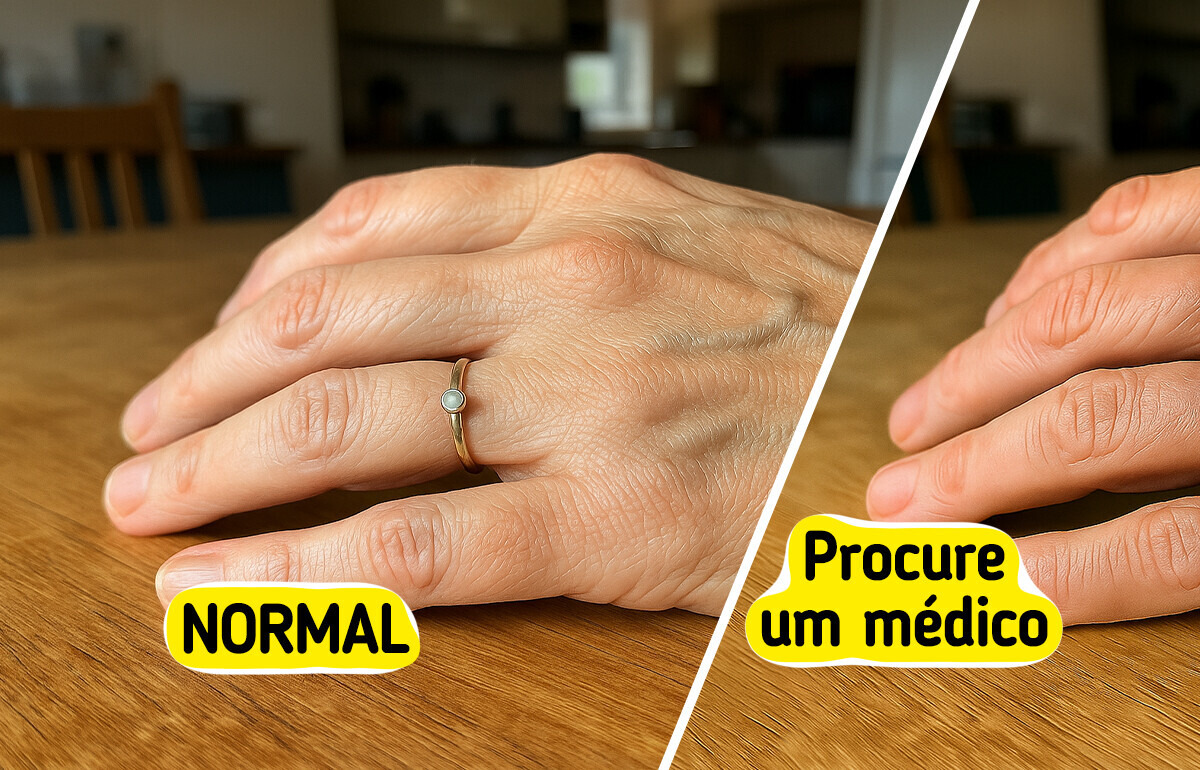 8 Sinais de que suas veias saltadas são um alerta para sua saúde