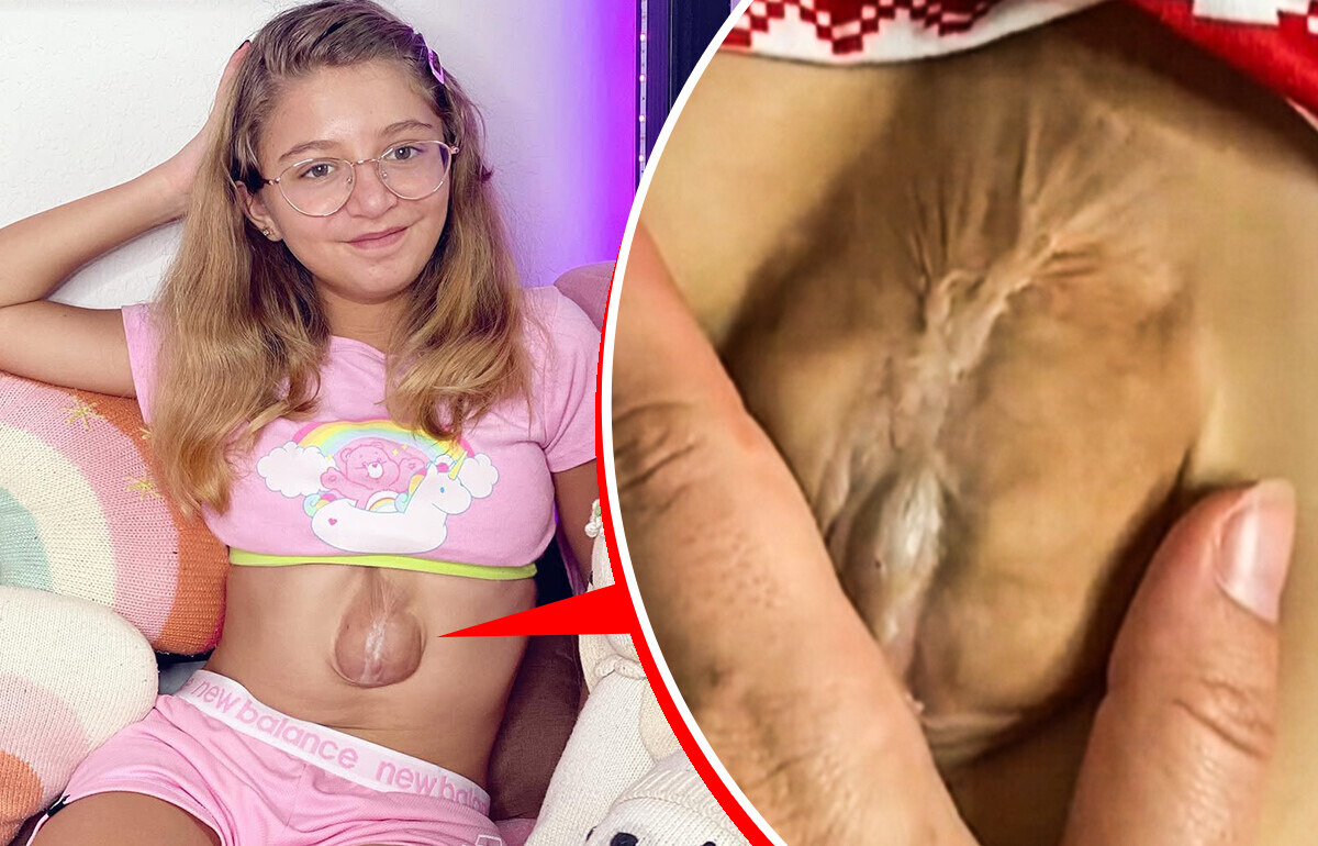 Menina vence as previsões médicas e emociona ao sobreviver com o coração fora do peito