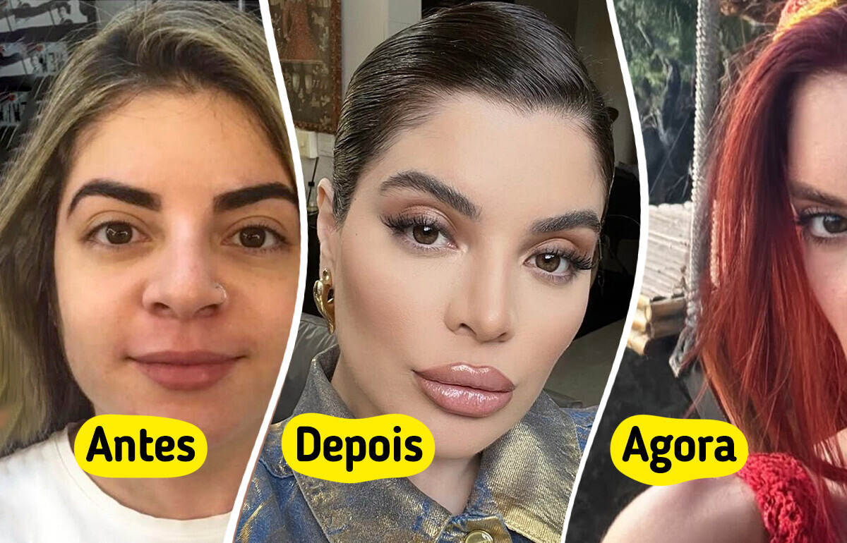 15 Estrelas que se arrependeram e fizeram uma desarmonização facial 15 Estrelas que se arrependeram e fizeram uma desarmonização facial