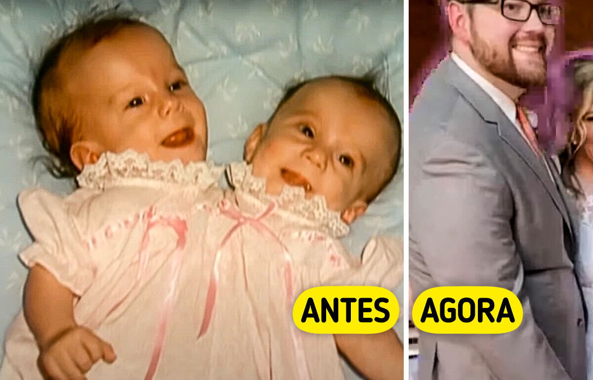 União inusitada: casamento de gêmea siamesa vira foco nas redes sociais União inusitada: casamento de gêmea siamesa vira foco nas redes sociais
