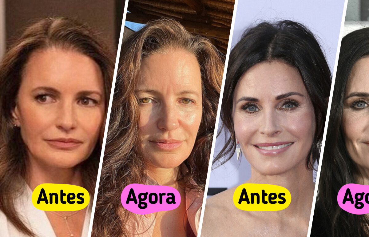 5 Celebridades que removeram seus preenchimentos faciais e adoraram os resultados