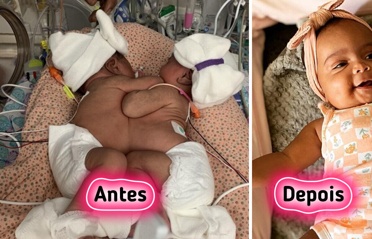 Os médicos superaram os riscos, e gêmeas siamesas são separadas com aplausos de alívio