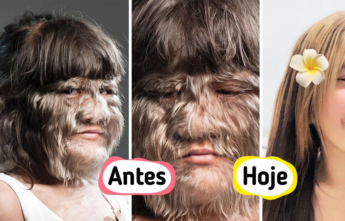 A “menina mais peluda do mundo” reaparece irreconhecível — e apaixonada A “menina mais peluda do mundo” reaparece irreconhecível — e apaixonada