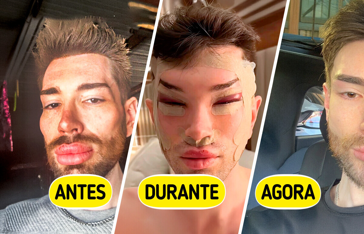 O influenciador “Ken Humano” desfez os preenchimentos e surpreendeu com sua nova versão O influenciador “Ken Humano” desfez os preenchimentos e surpreendeu com sua nova versão