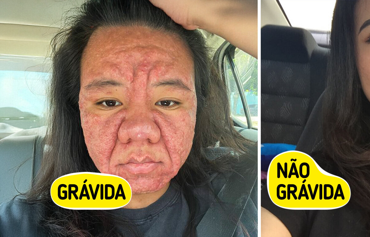 Mulher de 28 anos revela como a gravidez mudou drasticamente seu rosto Mulher de 28 anos revela como a gravidez mudou drasticamente seu rosto