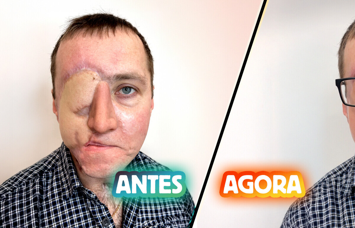 Tatuadora transforma cicatriz em arte com tatuagem hiper-realista no olho de sobrevivente de acidente