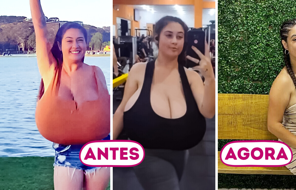 Jovem passa por cirurgia para reduzir seios de 10 kg e desabafa sobre os desafios da gigantomastia Jovem passa por cirurgia para reduzir seios de 10 kg e desabafa sobre os desafios da gigantomastia