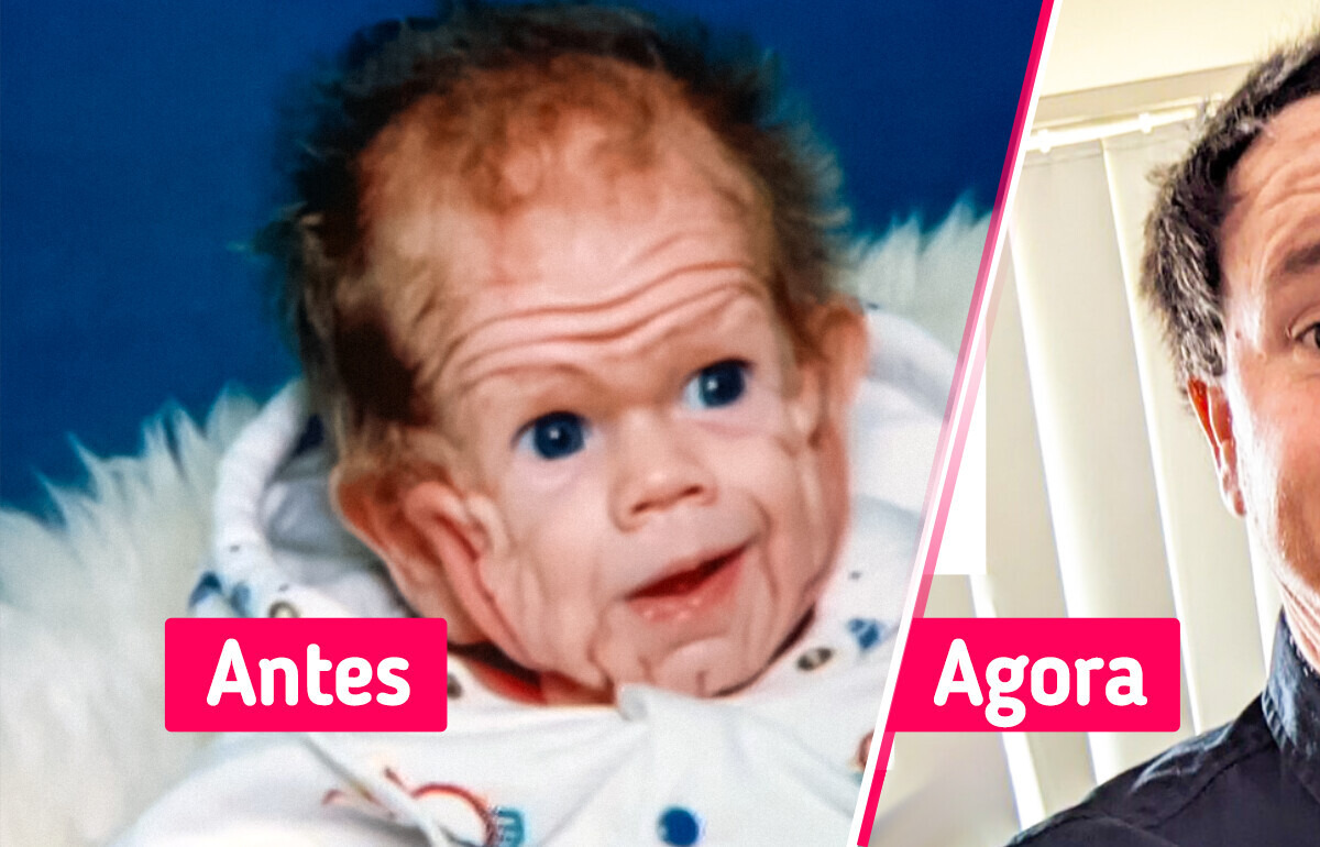 Um bebê nasceu com rara condição de pele que intrigou médicos por 20 anos