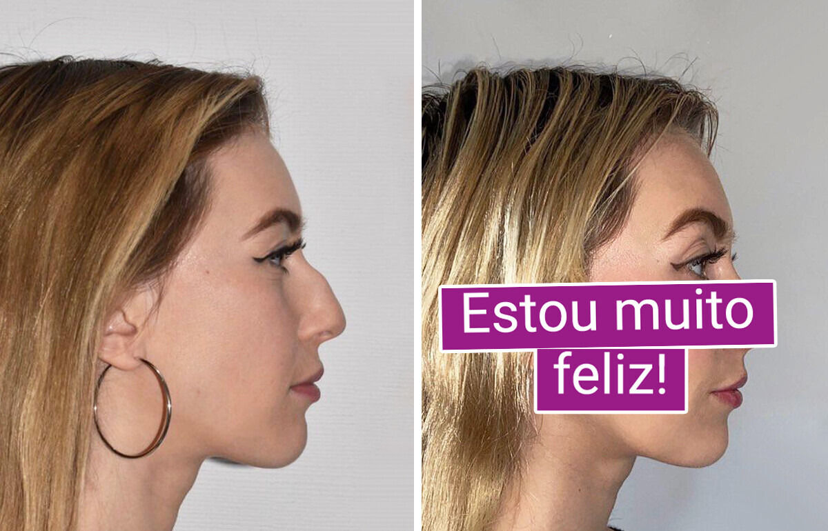 19 Histórias de quem fez cirurgia plástica e decidiu investir na melhor versão de si