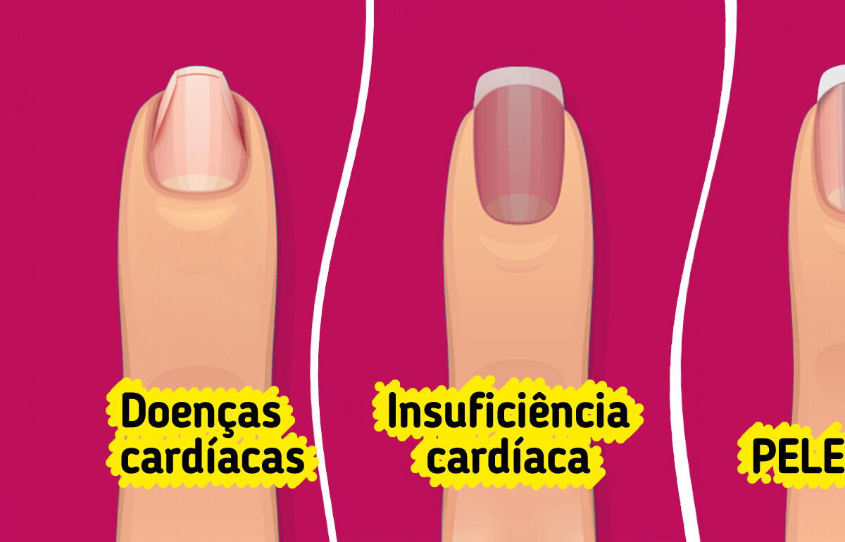 Seu corpo pode estar pedindo socorro e as unhas dão o primeiro sinal