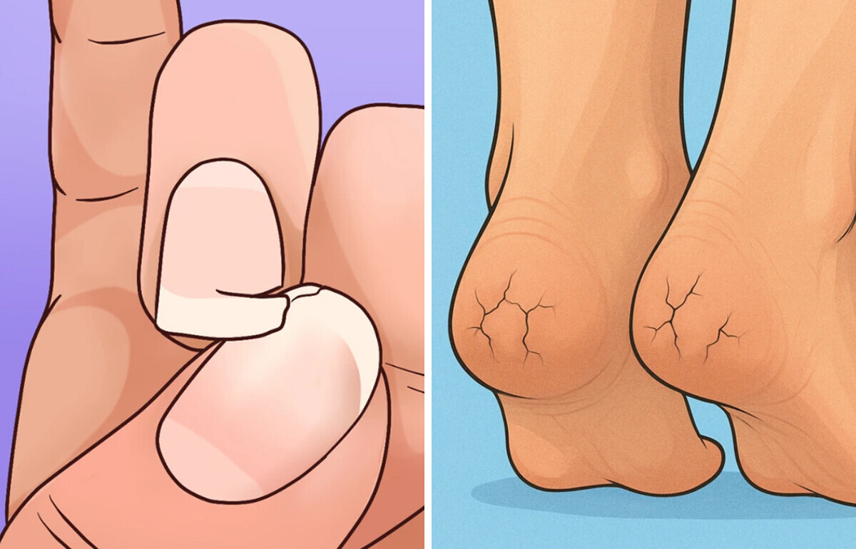 12 Sinais inesperados de que você pode ser intolerante a laticínios 12 Sinais inesperados de que você pode ser intolerante a laticínios