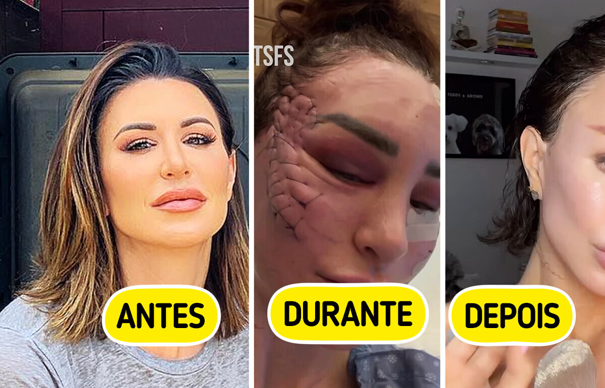 Mulher transforma o rosto com lifting “diferentão” e gera debate Mulher transforma o rosto com lifting “diferentão” e gera debate