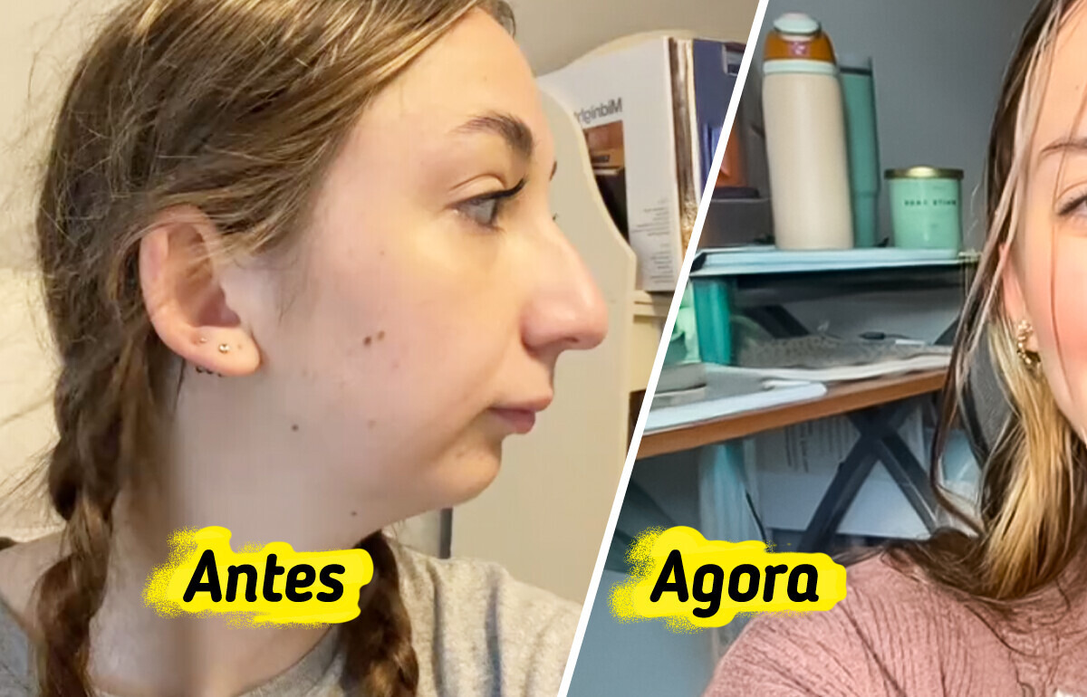 Jovem faz cirurgia na mandíbula e impressiona a internet com o resultado