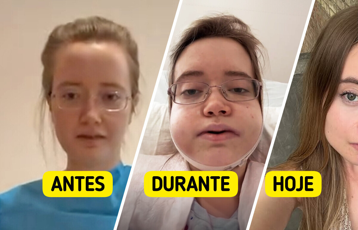 Cantora viaja 24 horas para fazer cirurgia na mandíbula e reaparece irreconhecível Cantora viaja 24 horas para fazer cirurgia na mandíbula e reaparece irreconhecível