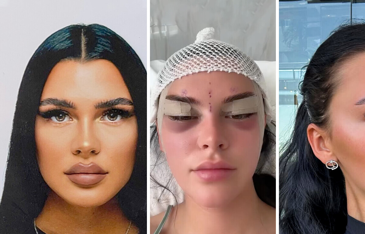 Cirurgia de “olhos de raposa” deixa jovem dividida entre apoio e críticas