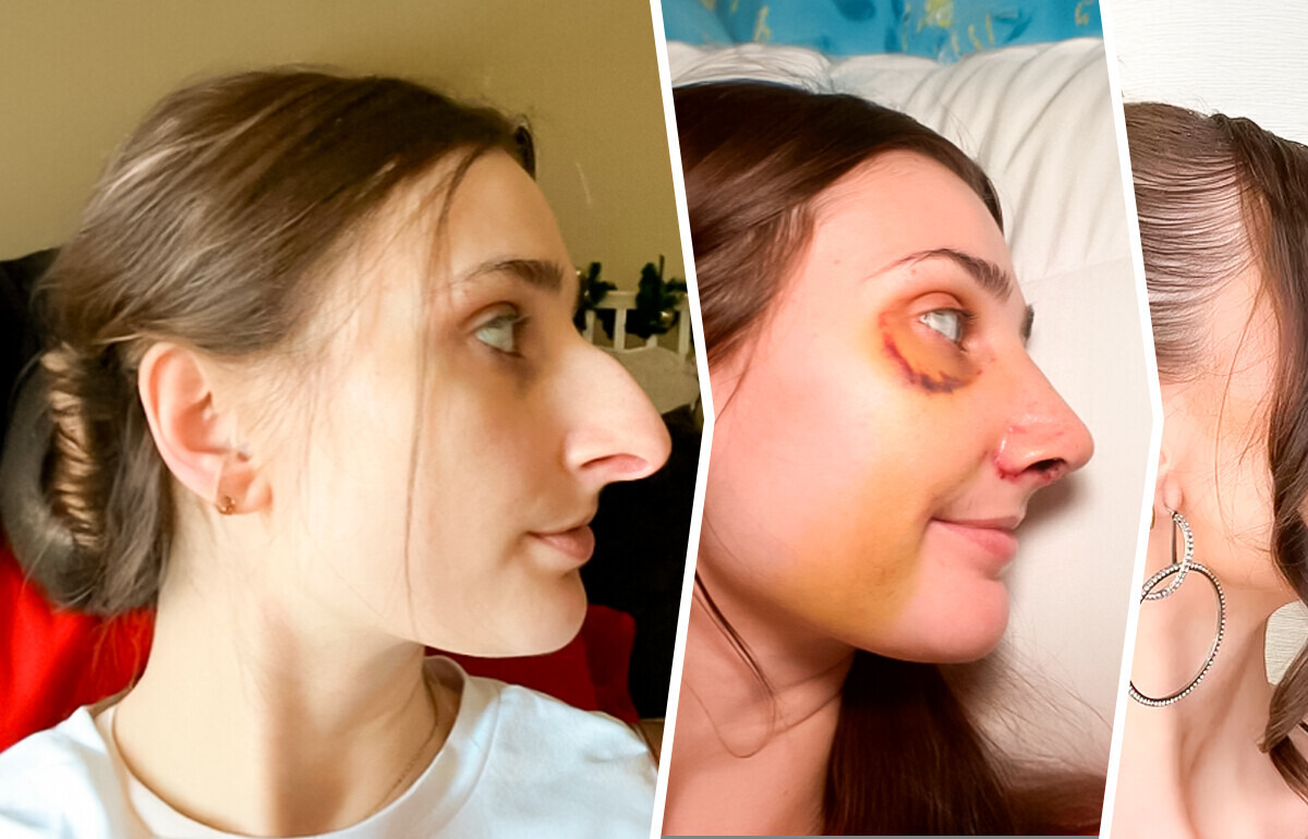 Jovem guarda dinheiro por 12 anos para rinoplastia, e o resultado foi espantoso Jovem guarda dinheiro por 12 anos para rinoplastia, e o resultado foi espantoso