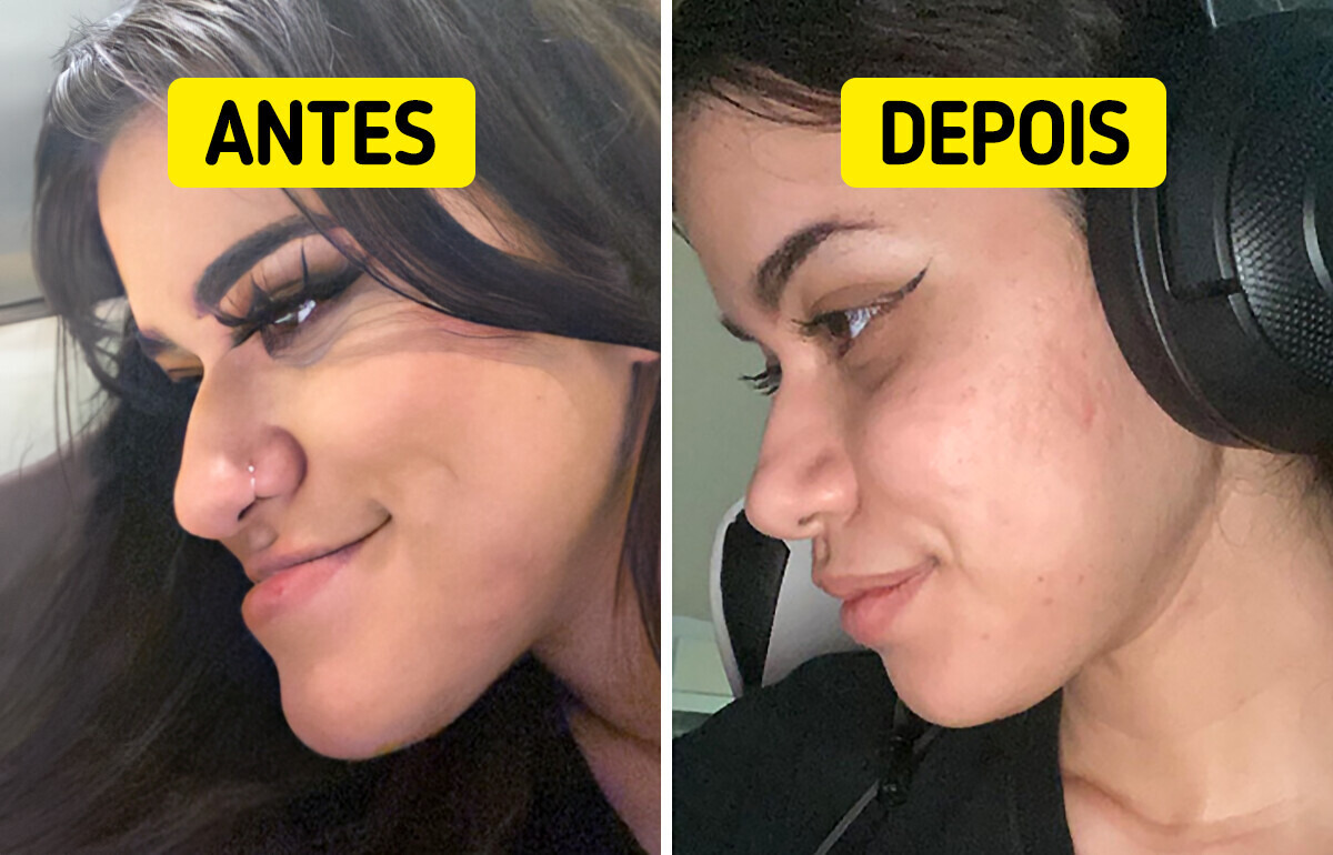 15 Pessoas que melhoraram sua imagem com cirurgia plástica