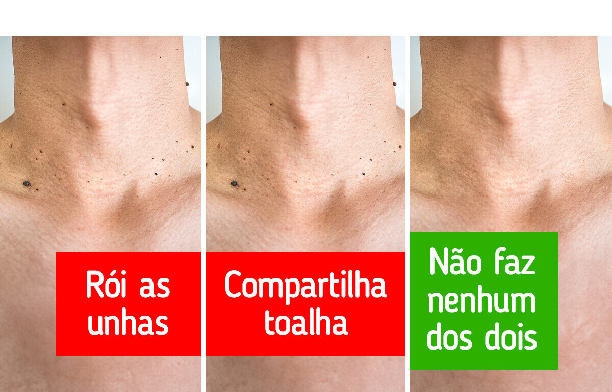 7 Maneiras eficazes de evitar o surgimento de verrugas