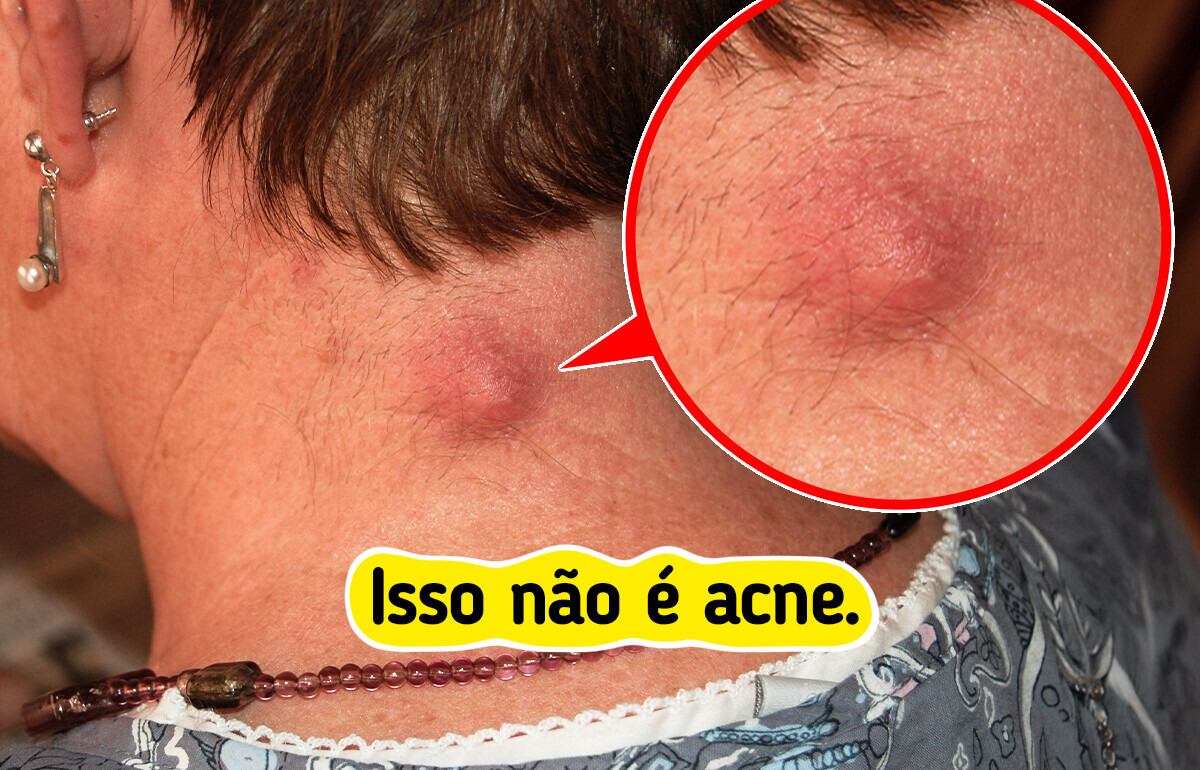 7 Bolinhas que parecem acne, mas podem ser outro problema na sua pele 7 Bolinhas que parecem acne, mas podem ser outro problema na sua pele