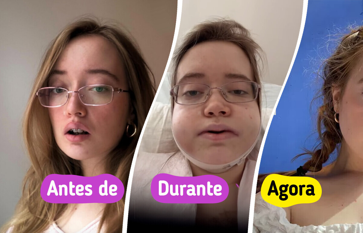 Cantora revela como a cirurgia de mandíbula dupla mexeu com sua autoestima e rotina