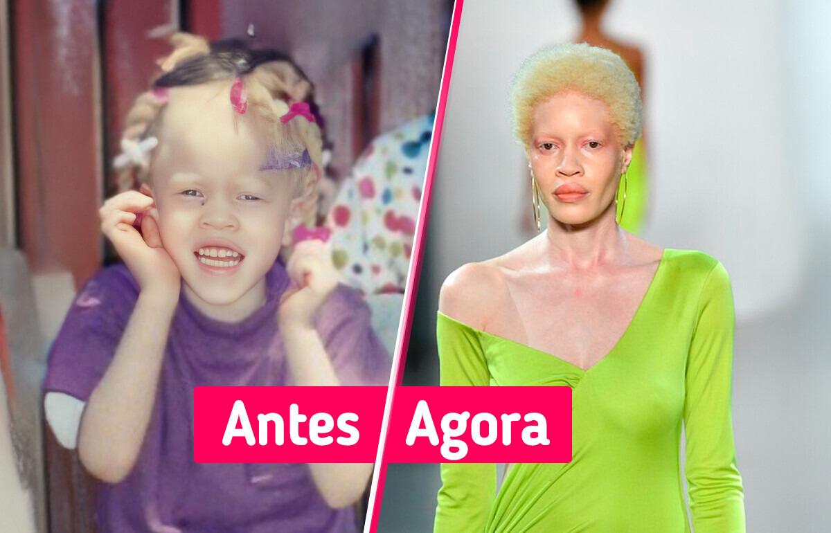 Alvo de bullying por albinismo, ela virou estrela nas passarelas do mundo