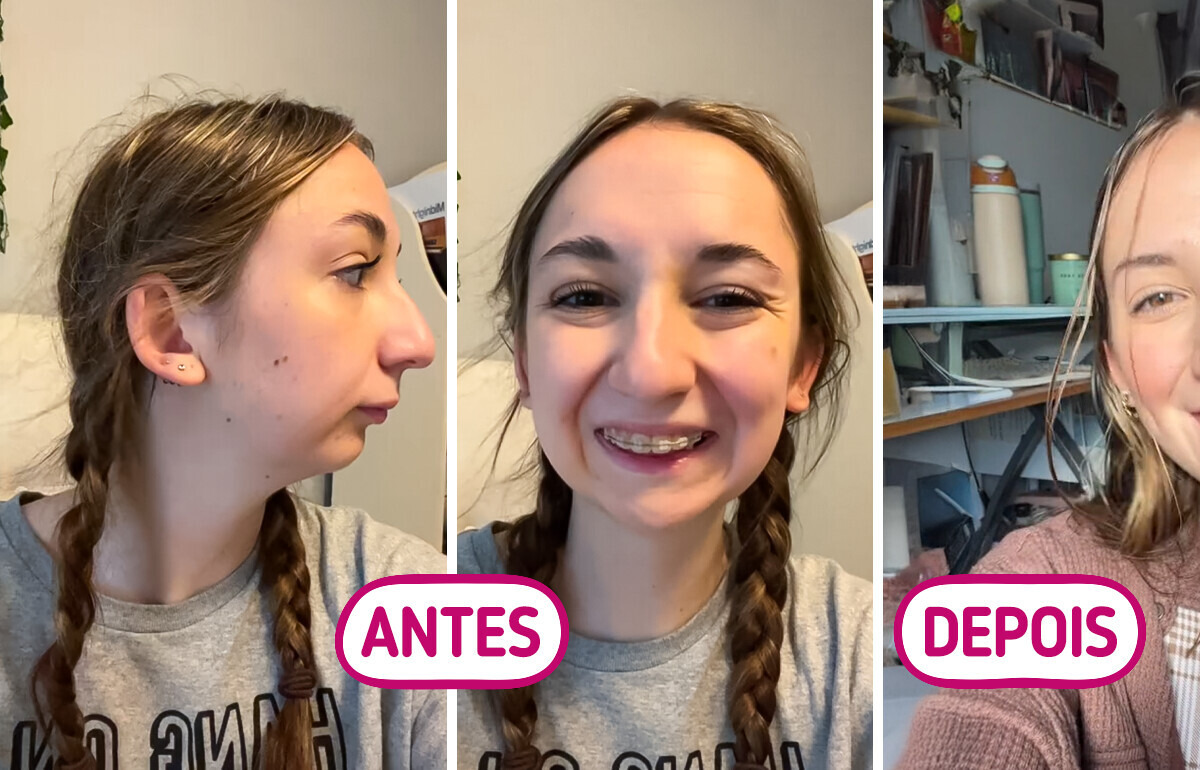 Jovem compartilha antes e depois da cirurgia mandibular e choca o público com o resultado Jovem compartilha antes e depois da cirurgia mandibular e choca o público com o resultado