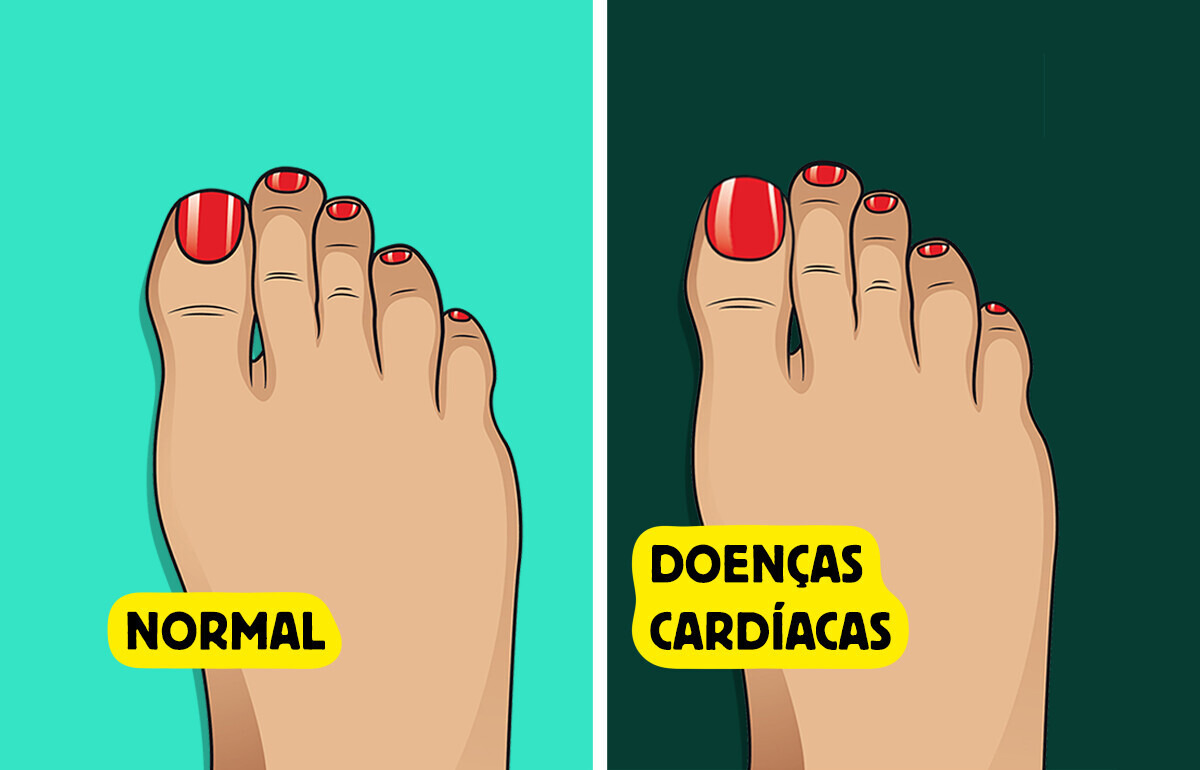 5 Sinais de saúde que suas unhas dos pés podem revelar sobre seu corpo