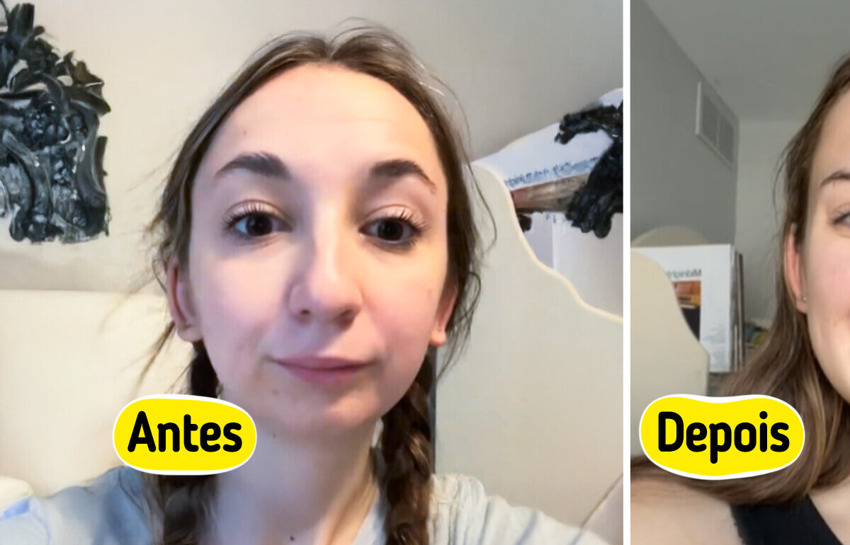 Essa jovem se transformou com uma cirurgia na mandíbula e gerou enxurrada de reações