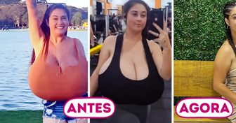 Ela enfrentou a gigantomastia, fez cirurgia para reduzir os seios de 22 quilos e resgatou a autoestima