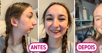 Jovem compartilha antes e depois da cirurgia mandibular e choca o público com o resultado