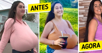 Brasileira de 21 anos supera gigantomastia e retira 10 kg de mama