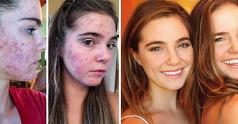 Gêmeas contam como venceram a acne mudando a alimentação
