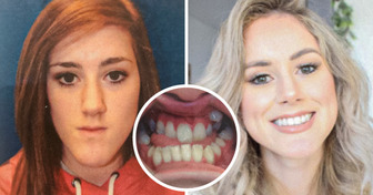15+ Pessoas que encararam o aparelho ortodôntico e agora não largam o espelho