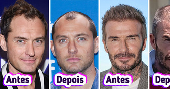 12 Famosos que nunca admitiram ter feito implante, mas o cabelo apareceu magicamente