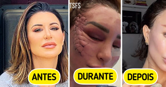Mulher transforma o rosto com lifting “diferentão” e gera debate