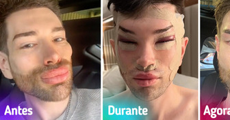 Homem mostra resultado de cirurgia plástica nos olhos e para remover preenchimentos faciais, deixando todos chocados
